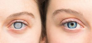 Cataracts