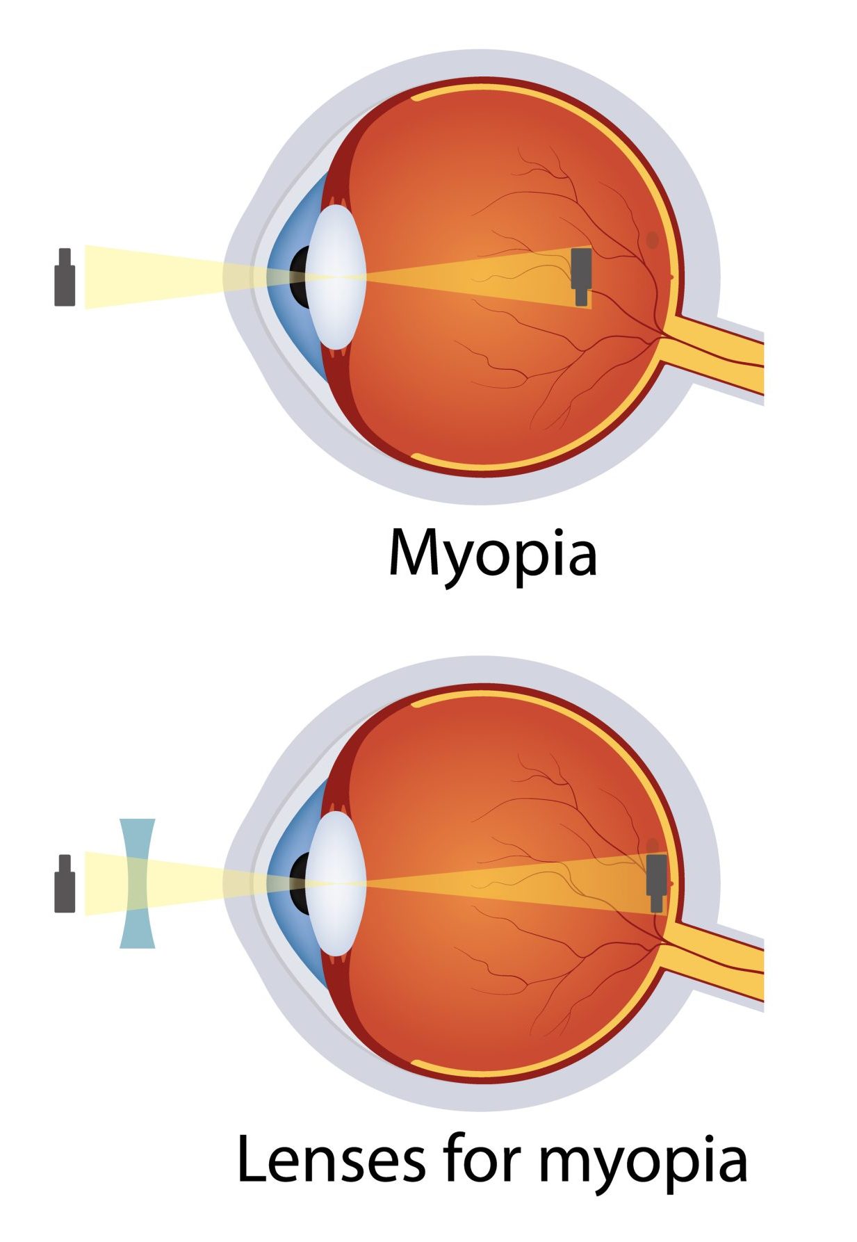 Hyperopia and myopia corrected by lens