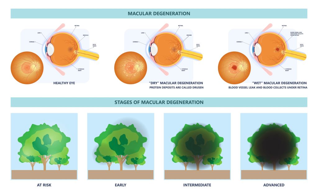 macular degeneration hemorrhage dry wet